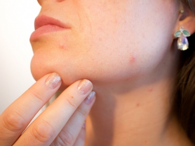 Sei stanca di avere l'acne? Scopri come sconfiggerla in modo naturale! 